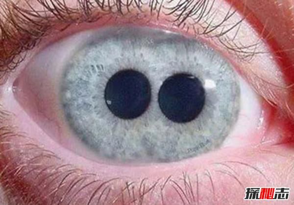 什麼是雙瞳孔？世界上有雙瞳孔的人嗎？(中國史書記載共八人) – 頭條新聞
